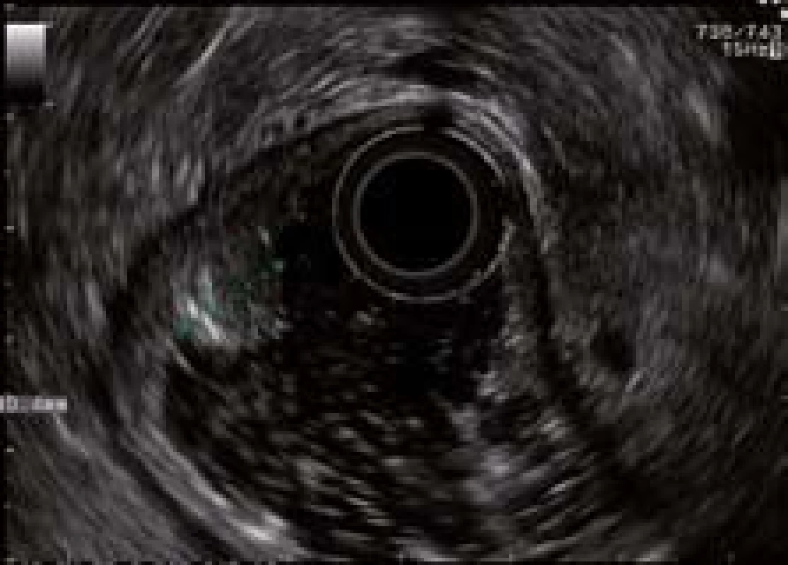 Radiální endosonografie. Stejná léze jako na obr. 1.
Fig. 2. Radial endosonography. Same lesion as in Fig. 1.