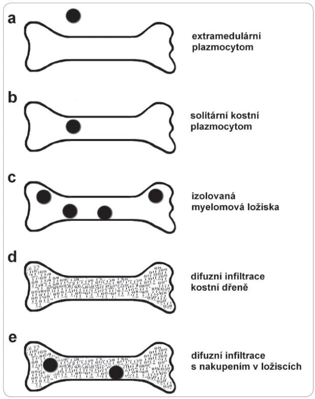 Způsob rozložení myelomových buněk v kosti je rozhodující pro typ kostního postižení (vznik porózy nebo osteolytických ložisek).
<em>Typ a:</em> ložiskové nahromadění myelomových buněk v měkkých tkáních.
<em>Typ b:</em> jedno lokalizované zmnožení myelomových buněk v kosti, které vede ke vzniku izolovaného osteolytického kostního ložiska.
<em>Typ c:</em> izolovaná myelomová ložiska ve skeletu bez difuzní infi ltrace kostní dřeně. Vede ke
vzniku izolovaných osteolytických ložisek bez difuzní osteoporózy. Při punkci mimo ložisko se neprokáže infi ltrace kostní dřeně.
<em>Typ d:</em> zcela difuzní infi ltrace kostní dřeně myelomovými buňkami bez ložisek nakupení. Způsobí difuzní odbourávání kosti, tedy difuzní osteoporózu.
<em>Typ e:</em> difuzní infi ltrace kostní dřeně s nakupením myelomových buněk v ložiscích. Vede ke vzniku osteolytických ložisek ve skeletu a k difuzní osteoporotizaci kosti. Na rozdíl od typu c prokáže necílená punkce kostní dřeně mimo ložisko infi ltraci kostní dřeně myelomovými buňkami.