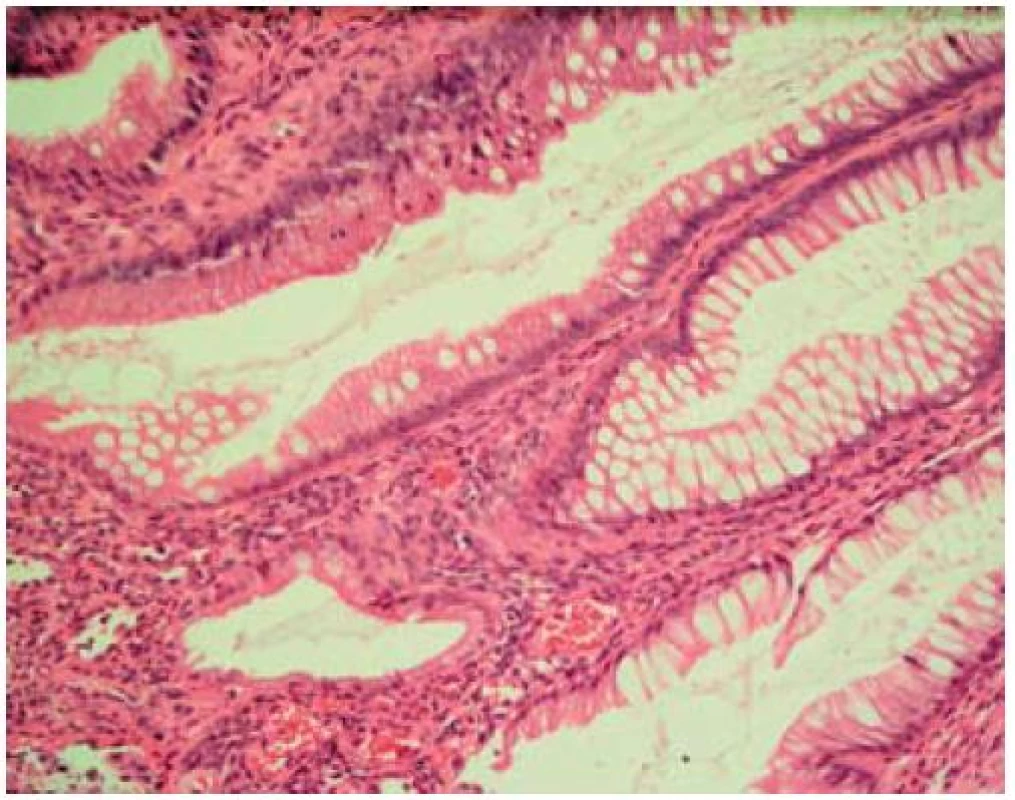Hyperplastická elongovaná krypta.
Fig. 4. Hyperplastic and prolonged crypt of Lieberkühn.