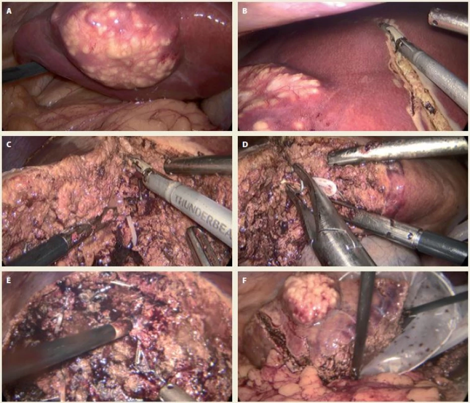 A. An echinococcal lesion in liver segment S5 (view of visceral surface of the liver); B. demarcation of the resection
line by an electrocoagulation tool (view of diaphragmatic surface of the liver); C. interruption of liver parenchyma by an
electrocoagulation tool; D. clipping of the vessel during the interruption of the liver parenchyma tissue; E. the use of argon
plasma coagulation in secondary haemostasis of the liver resection surface; F. placing the specimen in a protective
bag before extraction.<br>
Obr. 3 A. Echinokokové ložisko v segmentu S5 (pohled na viscerální plochu jater); B. vytyčení resekční linie elektrokoagulačním nástrojem (pohled na diafragmatickou plochu jater); C. pčerušování jaterního parenchymu elektrokoagulačním nástrojem;
D. ošetčení cév klipováním při přerušování jaterního parenchymu; E. ošetření resekční plochy jater pomocí argon plazma
koagulace; F. vložení resekátu do ochranného vaku před jeho následnou extrakcí