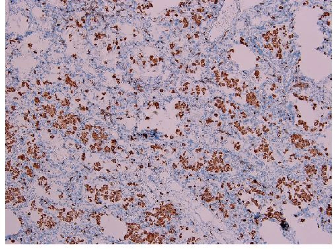 Imunohistochemický dôkaz CD68 v makrofágoch (imunohistochémia anti-CD68, zväčšenie 100x).