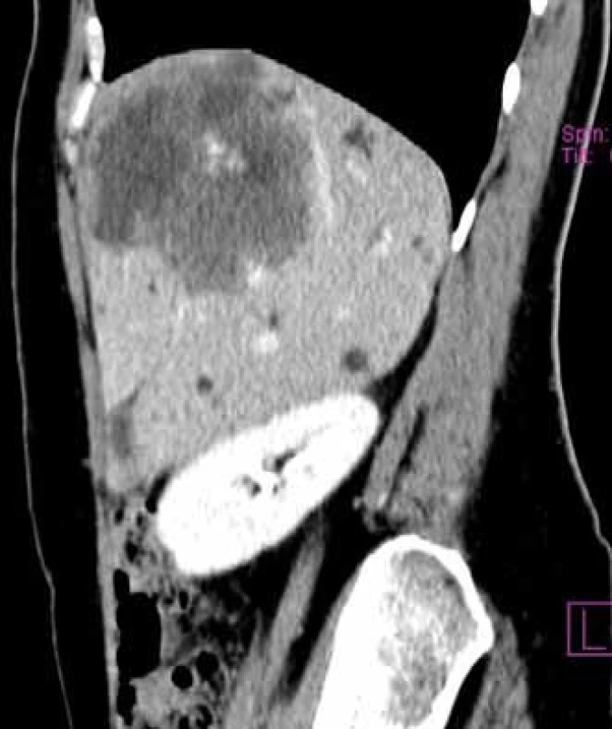 CT s kontrastom – sagitalna rekonštrukcia.
Fig. 2. CT scan with contrast. Sagittal reconstruction.