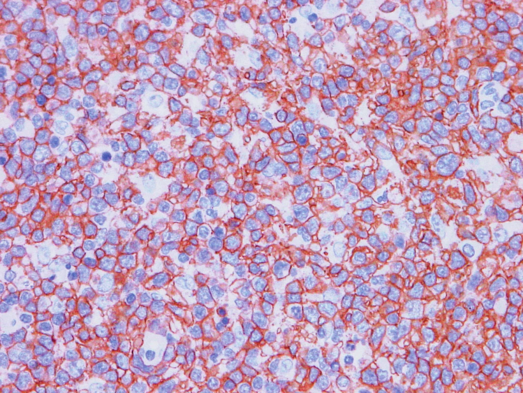 Vzorek z 2. bioptického odběru – DLBCL 
CD20 pozitivita velkých buněk.
