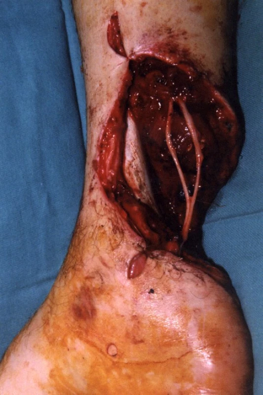 Peroperačně přemostění defektu n. tibialis nervovým štěpem n. suralis