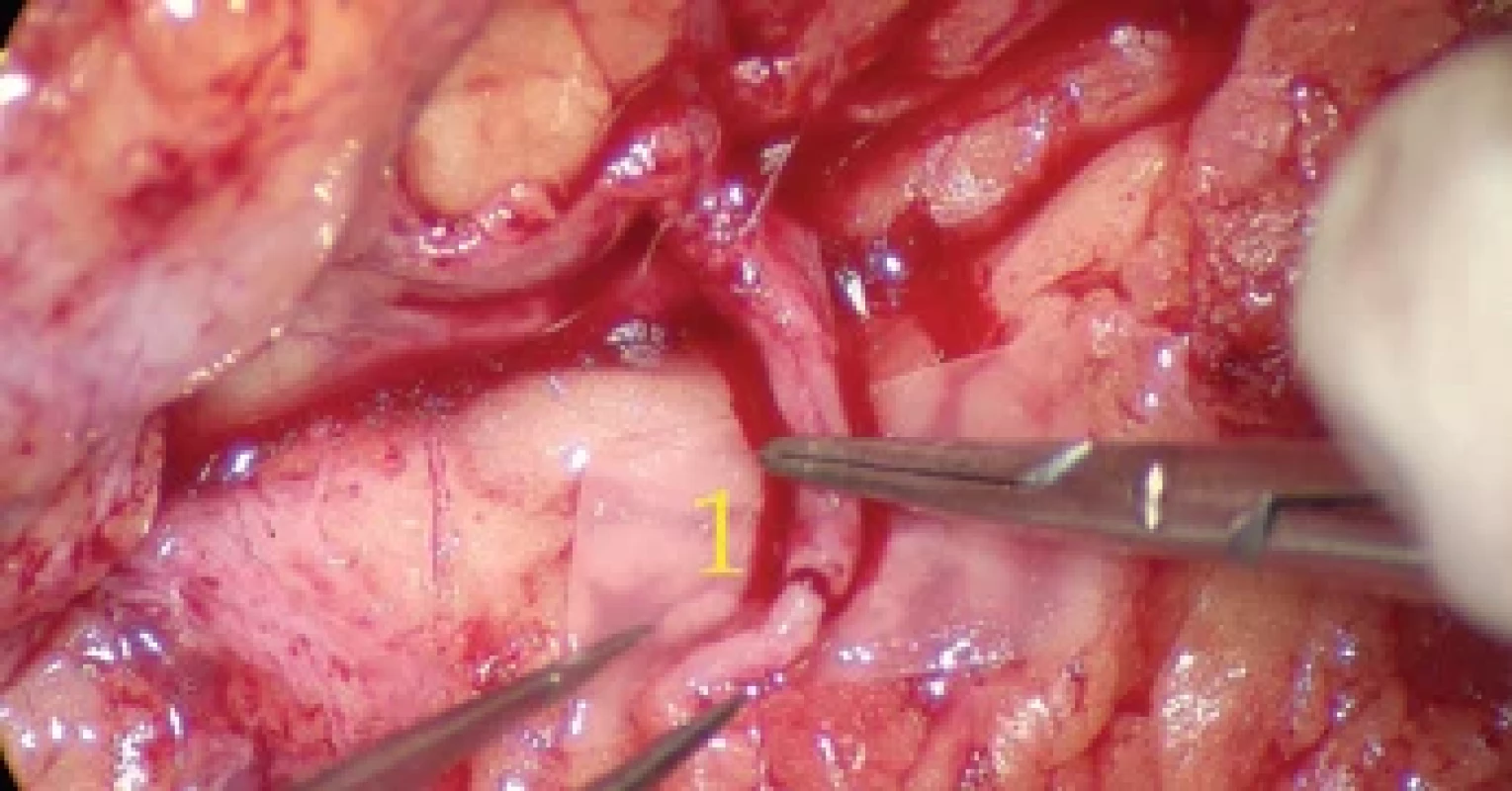 First end-to-end LVA. Vein upwards. Lymphatic collector with fi rst stitch downwards.