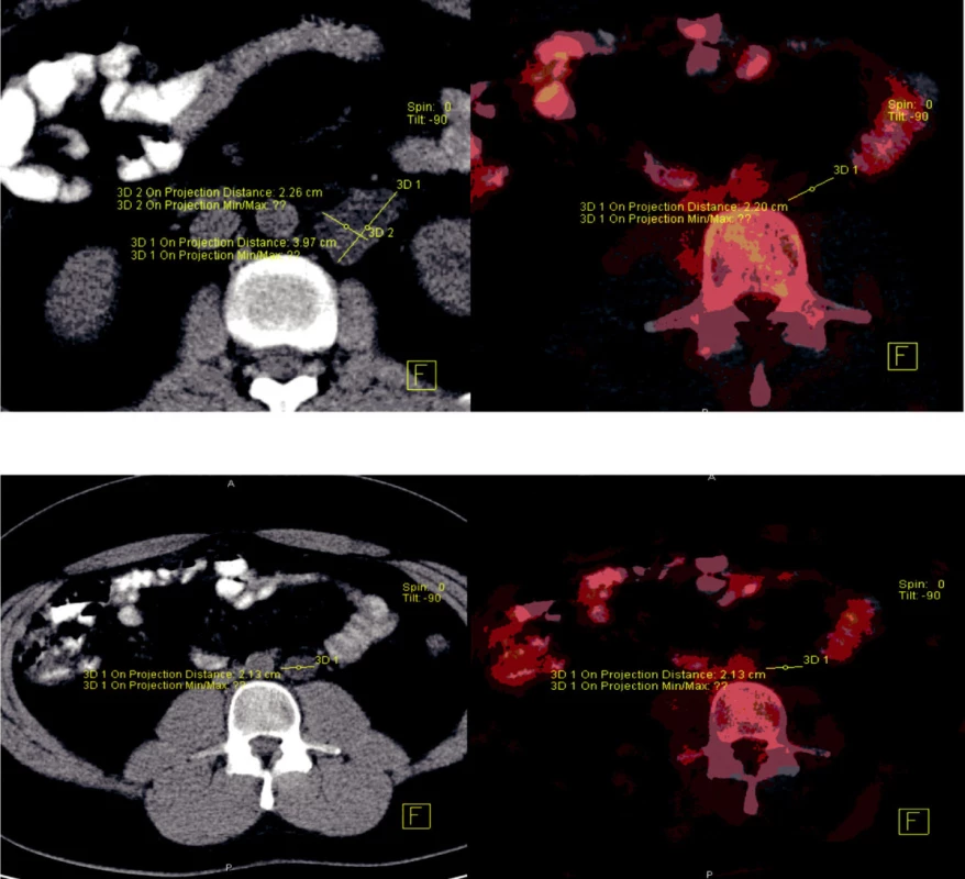 PET/CT pacienta s perzistující retroperitoneální masou po chemoterapii