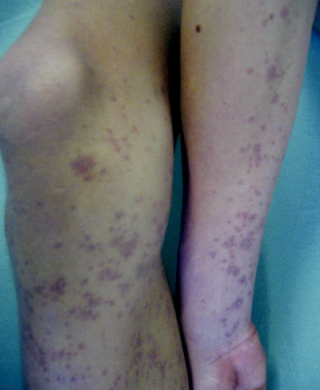 Gloves and socks syndrome, 17-ročný chlapec (parvovírus B19)