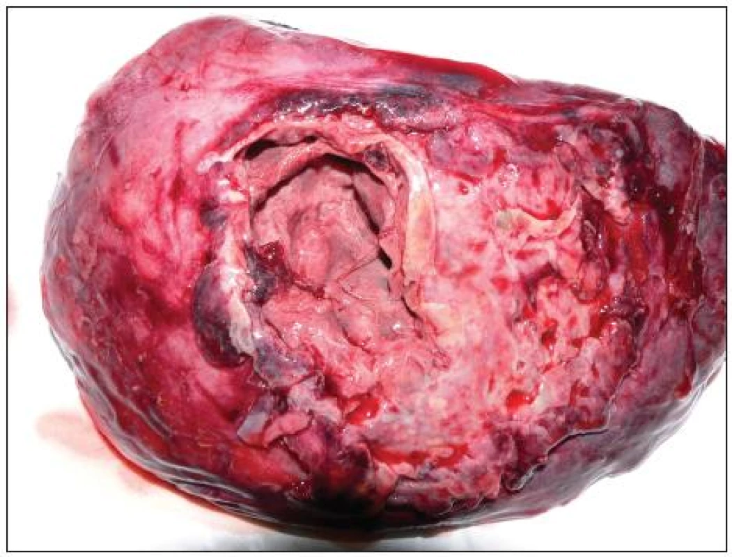 Horní lalok pravé plíce s píštělí (kazuistika č. 2)
Fig. 3. Fistula of right superior pulmanory lobe (case report No. 2)