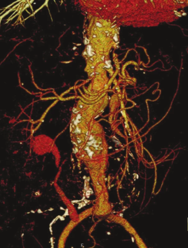 CTA předoperační nález
Fig. 9: CTA preoperative finding