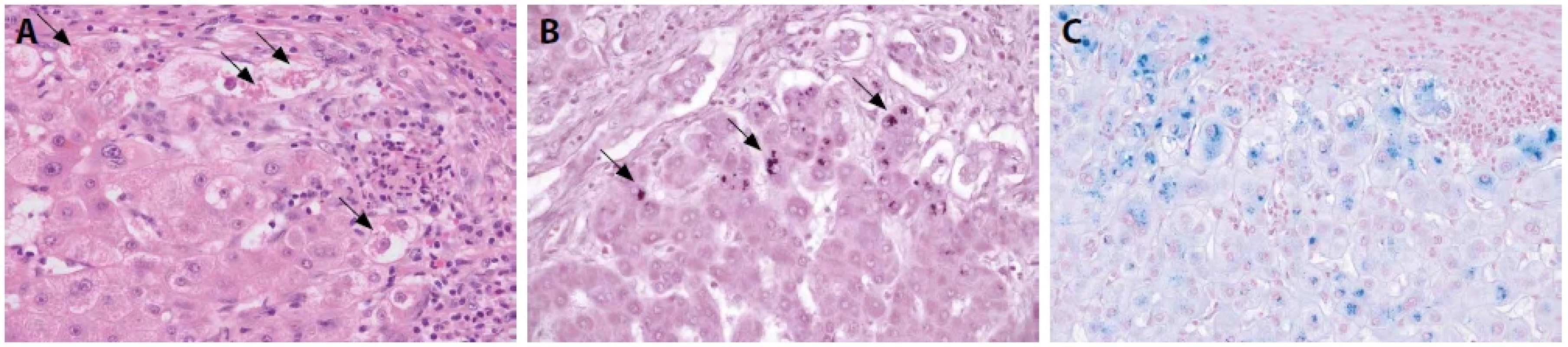Chronická cholestáza – stáza cholátů. Péřovitá degenerace hepatocytů s inkluzemi Malloryho-Denkova hyalinu – šipky. Barveno hematoxylinem eozinem (A, zvětšení 400x). Depozita metaloproteinu (B, C). Barveno orceinem – šipky (B, zvětšení 400x). Schmorlova reakce (C, zvětšení 200x).