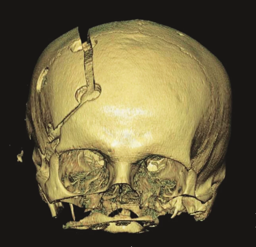 Nadzdvižená kostní ploténka ve stadiu edému mozku
Fig. 3. Cerebral edema lifting the bone plate