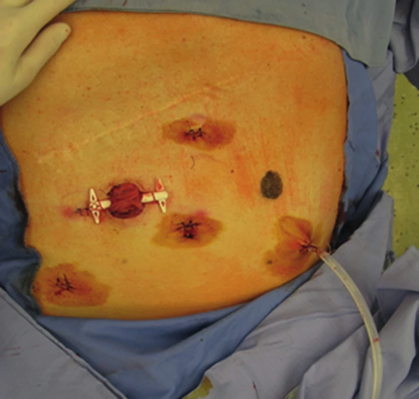 Výsledný stav po extrakci resekátu cestou ileostomie
Fig. 4: Final outcome after specimen extraction via ileostomy site
Autor: T. Grolich