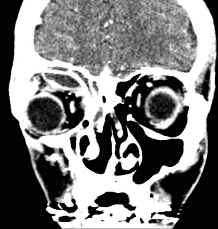Subperiostálny absces vpravo – axiálna projekcia.