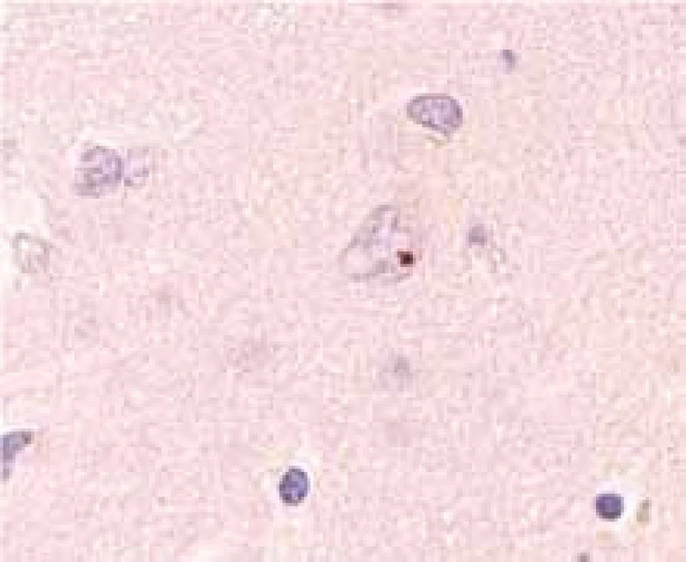 Intranukleární inkluze obsahující huntingtin.
(Zapůjčeno MUDr. R. Matějem, Ph.D., odd. patologie, Fakultní Thomayerova nemocnice s poliklinikou, Praha.)