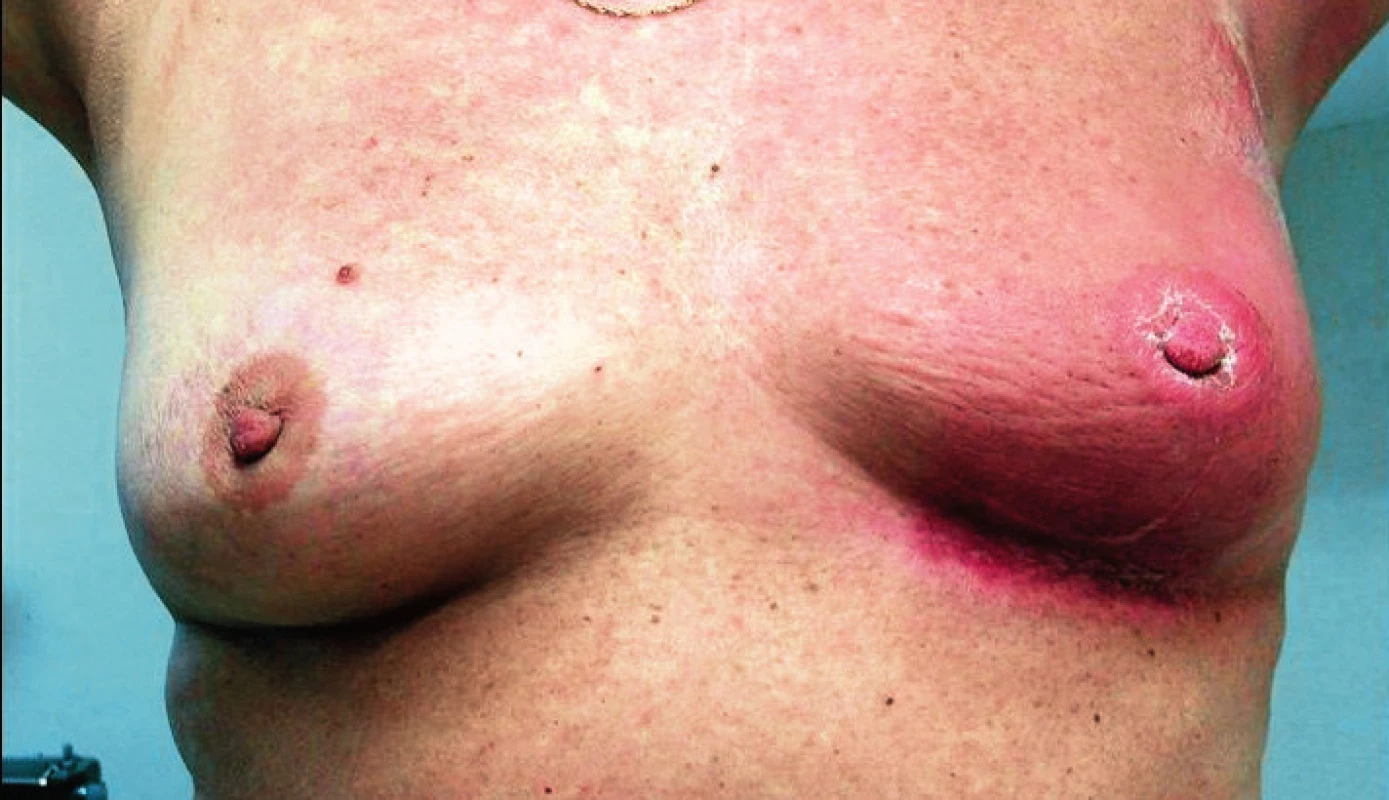 Inflamatorní karcinom