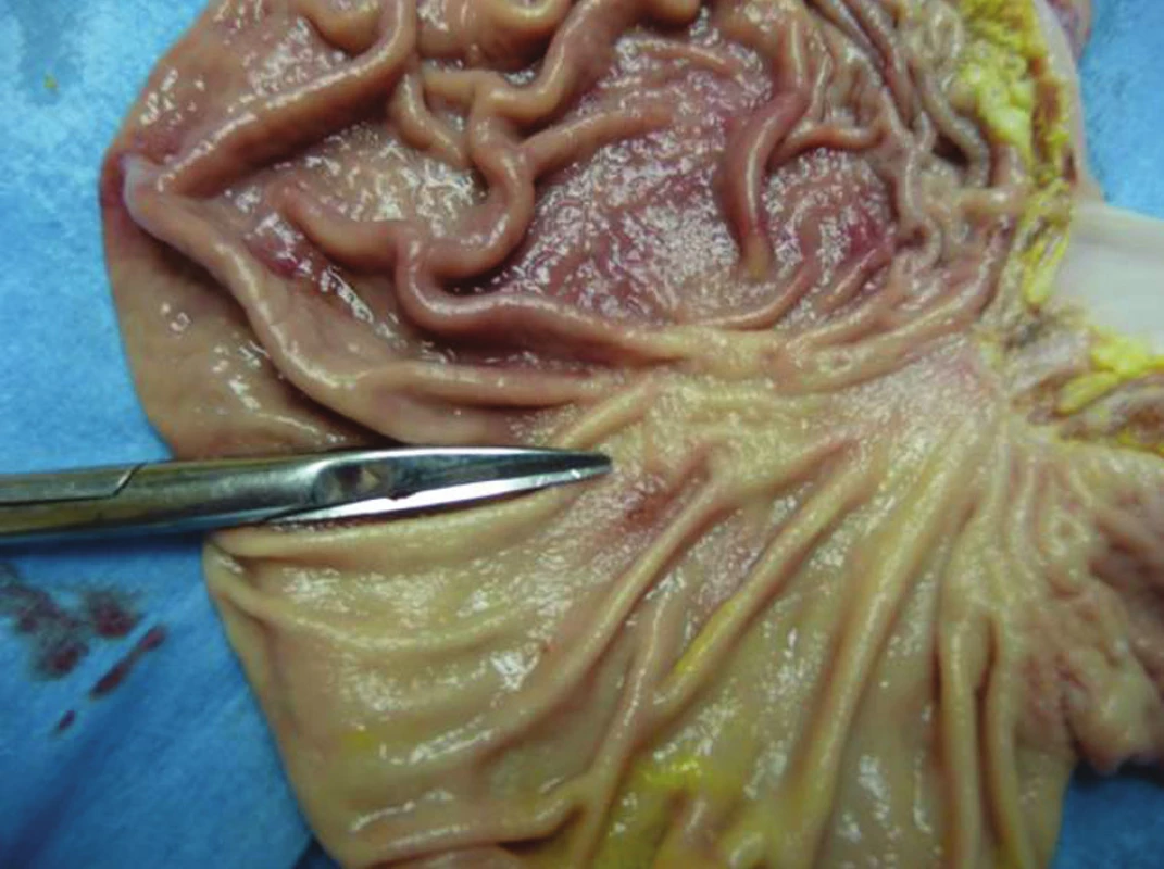 Žaludek po odstranění OTSC klipu
Fig. 3: Stomach after the OTSC clip removal