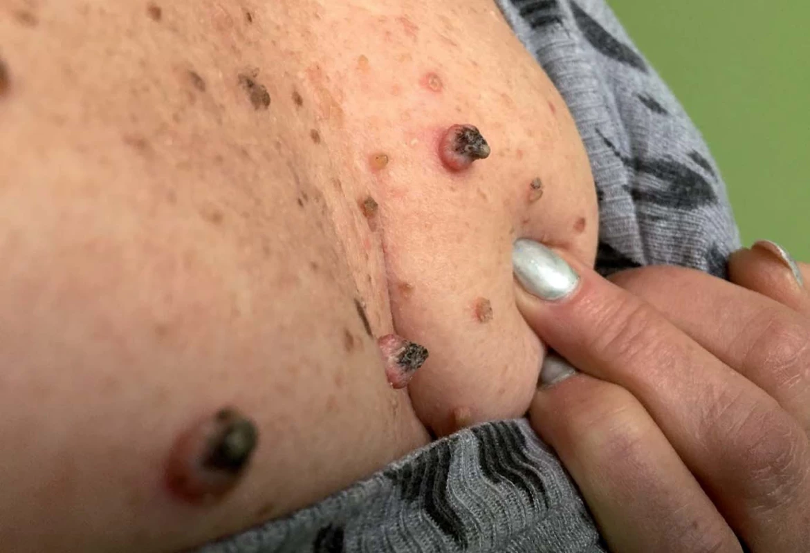 Indukce sekundárních malignit – spino CA či ložisek cornu cutaneum.