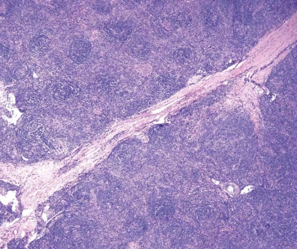 Hyalinně-vaskulární typ morfologie u případu UCD se zmnoženými folikuly s regresivně změněnými zárodečnými centry a fibrózním septem. Interfolikulární oblast je rozšířena proliferací postkapilárních venul (hematoxylin-eosin, 40x).
