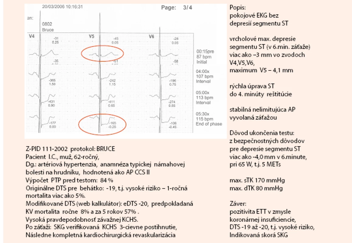 Kazuistika – záťažový test pacienta s typickou námahovou bolesťou na hrudníku (1. časť).
Dokumentácia: archív autorky