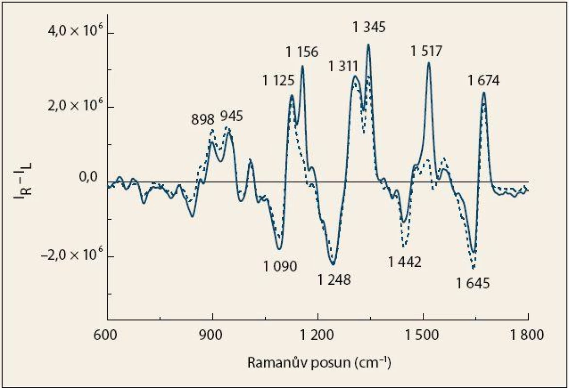 Průměrná spektra ROA krevní plazmy pacientů s karcinomem pankreatu (čárkovaná čára) 
a kontrolních jedinců (plná čára).
Fig. 2. The average ROA spectra of blood plasma from patients with pancreatic cancer (dashed line) and control subjects (solid line).