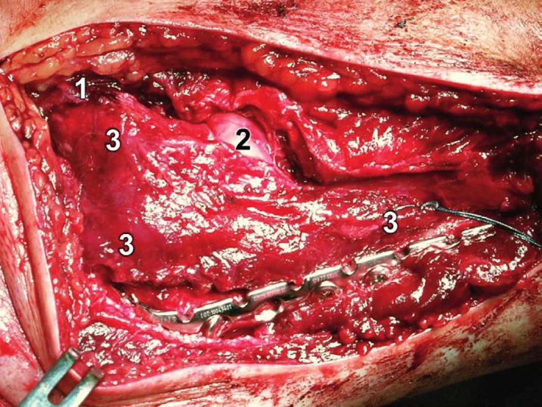 Rozšířený modifikovaný Kocherův přístup – reinzerce m. anconeus: 1 – lig. collaterale lat., 
2 – hlavice radia, 3 – m. anconeus
Fig 20: Extended modified Kocher approach – reinsertion of anconeus: 1 – lateral collateral ligament, 2 – radial head, 3 – anconeus
