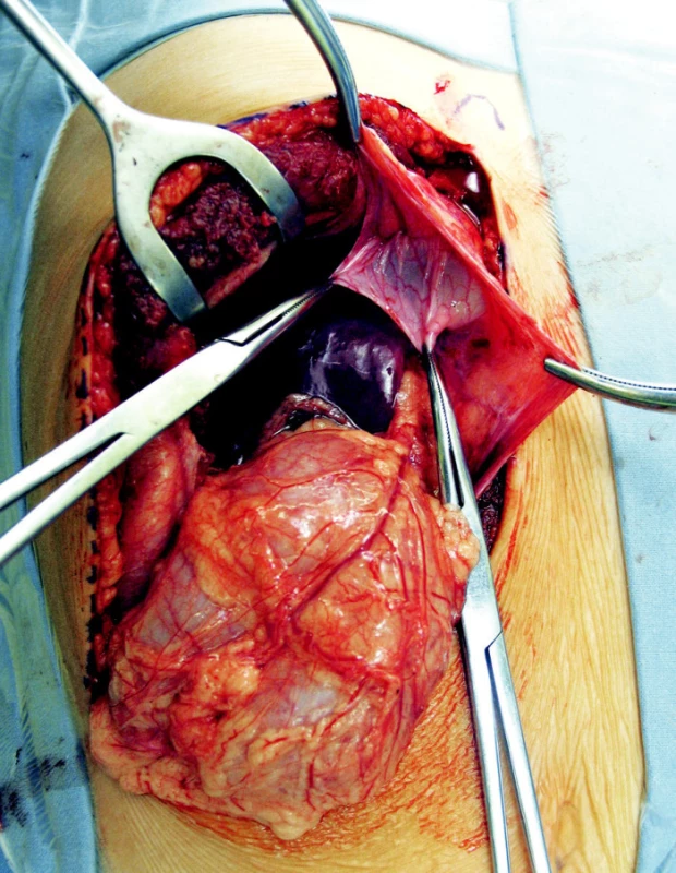 Pri elektívnej laparotomii zistená pravá Morganiho hernia, bránka v priemere 3 cm, vak dĺžky 10 cm, peroperačne už bez obsahu
Fig. 6. Morgagni hernia detected upon elective laparotomy, the orifice 3 cm in a diameter, the sac of 10 cm, intraoperatively no content detected.