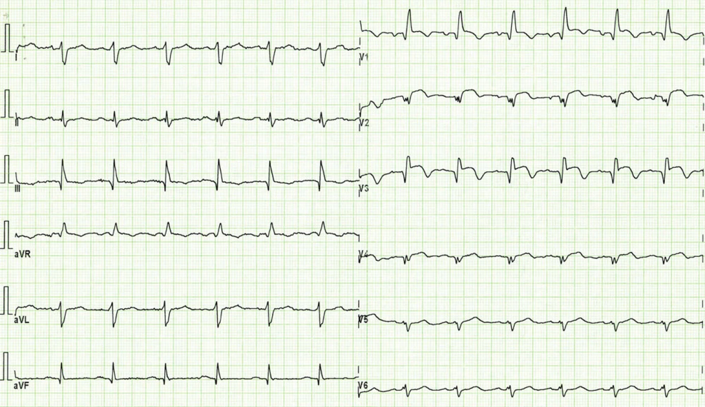 EKG při přijetí pacientky. Blok pravého Tawarova raménka a známky subakutního infarktu myokardu na přední stěně s elevacemi ST segmentu a již vytvořenými Q vlnami ve svodech V<sub>1</sub>– V<sub>5</sub>.