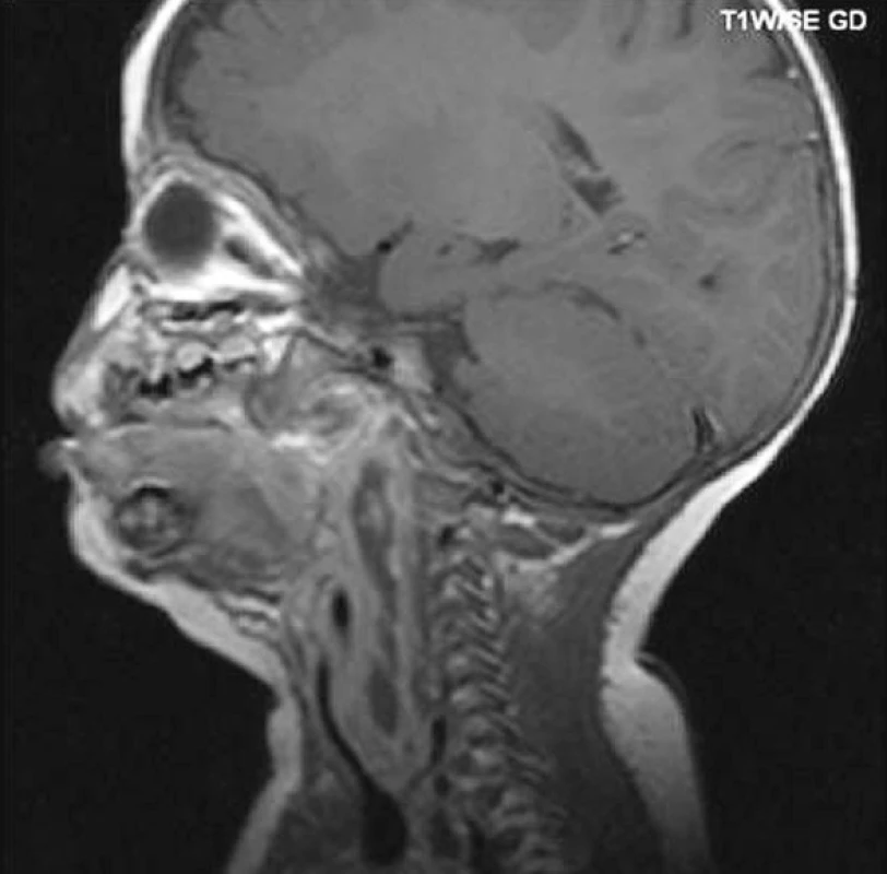 Abscesy v parafaryngeálním, retrofaryngeálním a prevertebrálním prostoru (NMR).