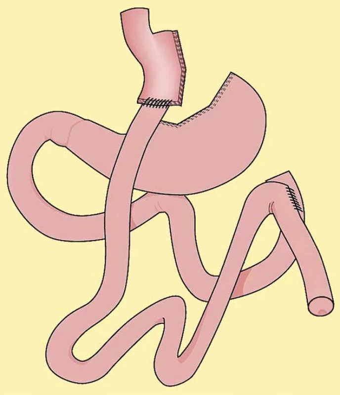 Roux-Y žaludeční bypass   Fig. 1: Roux-Y gastric bypass