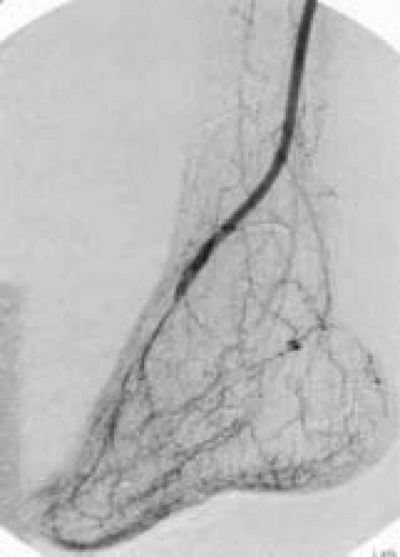 Angiografie 12 měsíců po provedeném bypassu s distální anastomózou na a. dorsalis pedis.