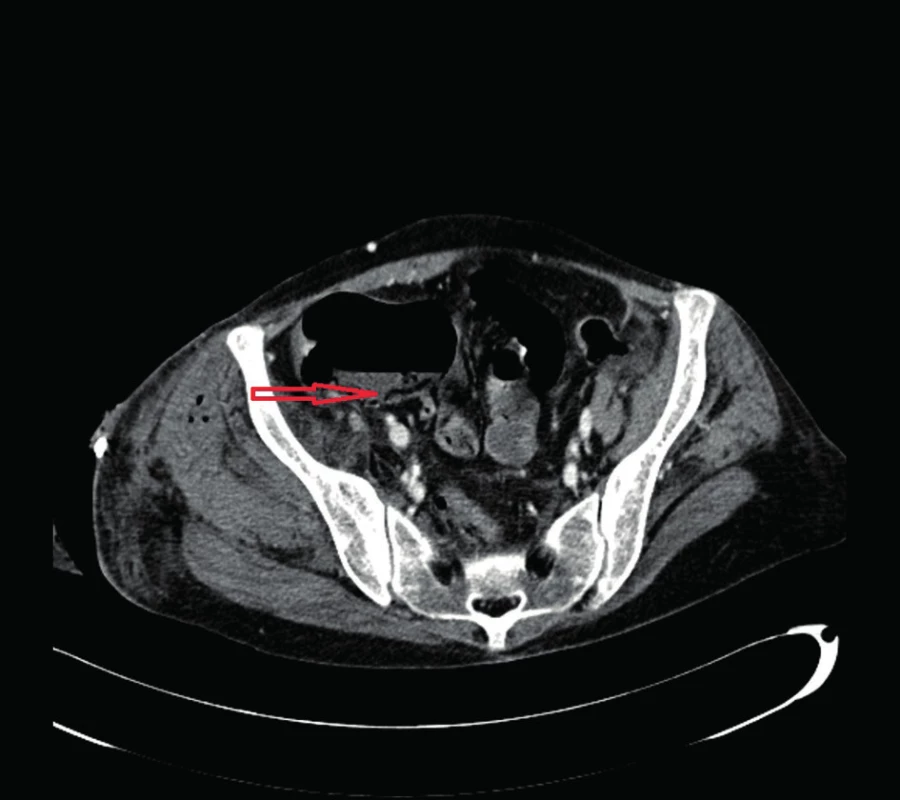 Pneumatoza steny colon ascendens
Fig. 1: Pneumatosis of the wall of the ascending colon