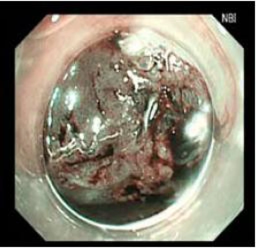 Stejné zobrazení jako obr. 1 v NBI.
Fig. 2. Imaging as in Fig. 1 in NBI.