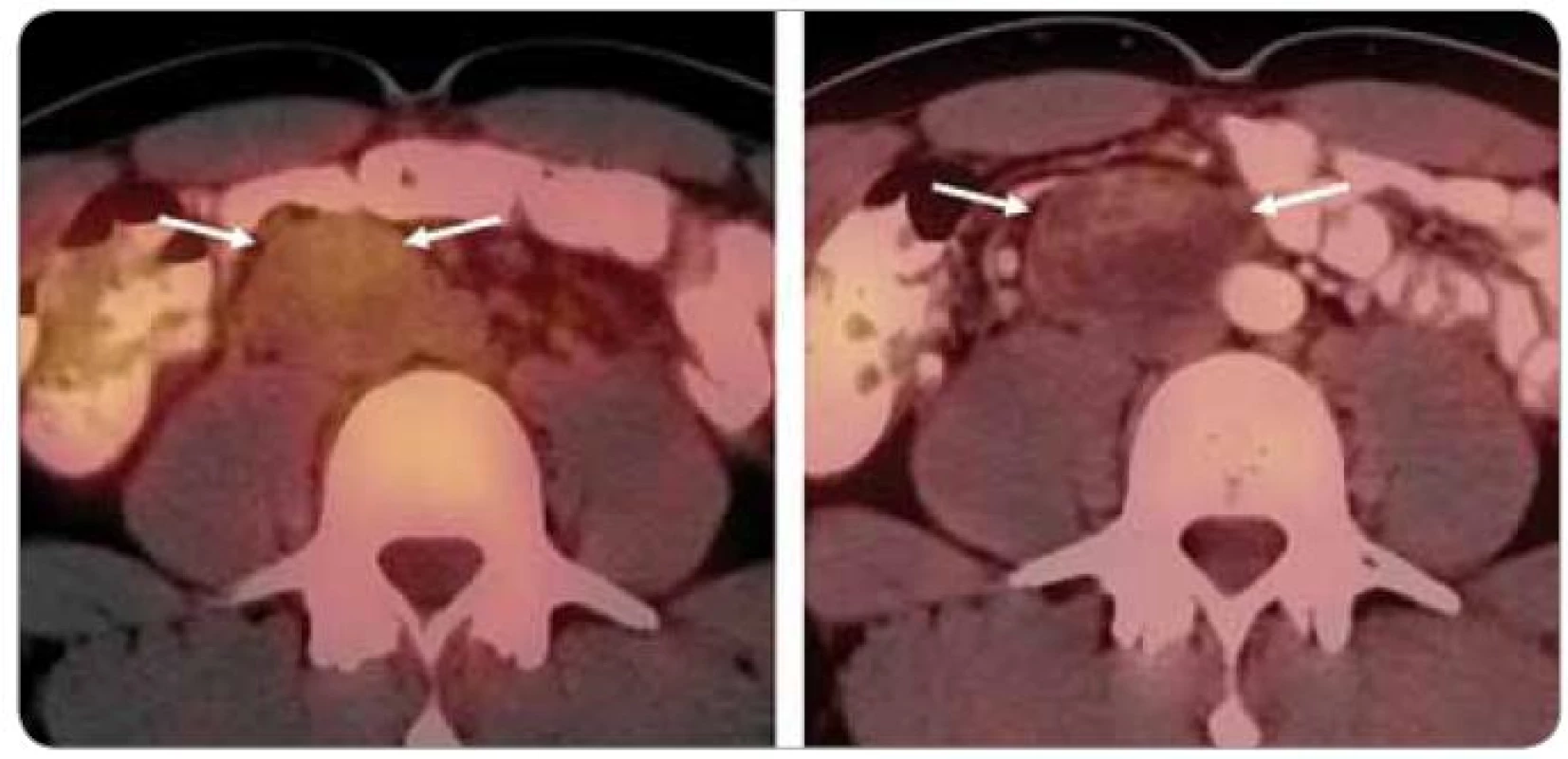 Obraz infiltrace nádorového rezidua v retroperitoneu makrofágy po chemoterapii – pravděpodobně se jedná o tzv. úklidovou reakci, přetrvávající viabilní neoplazii ovšem nebylo možné vyloučit (A). Na snímku provedeném v odstupu 3 měsíců již fotopenická masa charakteru nekrózy (B).