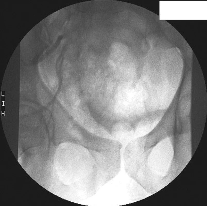 Arteriogram po selektivní embolizaci větví vnitřních ilických tepen, extravazace již neprokázána
Fig. 3. Angiography view after the selective embolisation of a branches of internal iliacal arteries, without extravasation