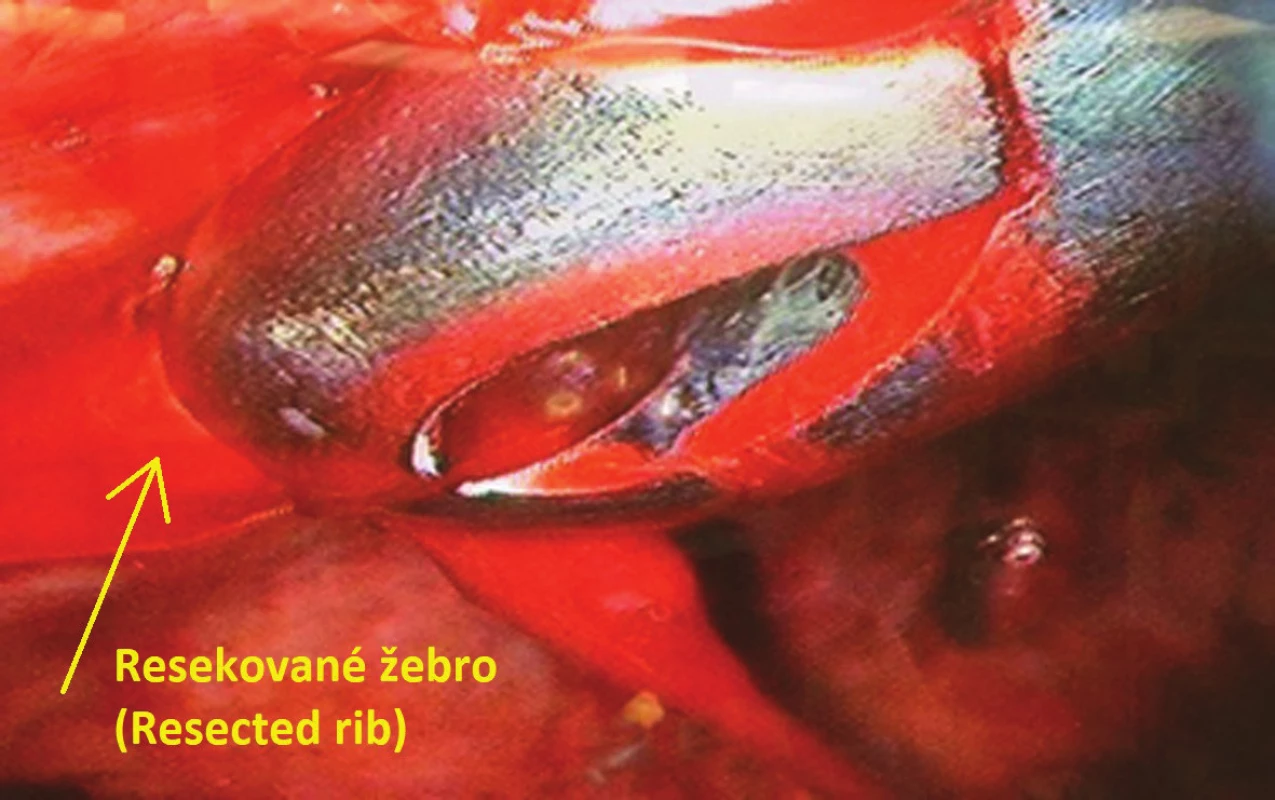 Uniportal VATS resekce vpáčeného žebra (pohled pomocí reverzní 30 stupňové optiky), šipka ukazuje na resekované žebro
Fig. 3: Uniportal VATS rib resection (30-degree reversed optic view), the arrow pointing to the resected rib