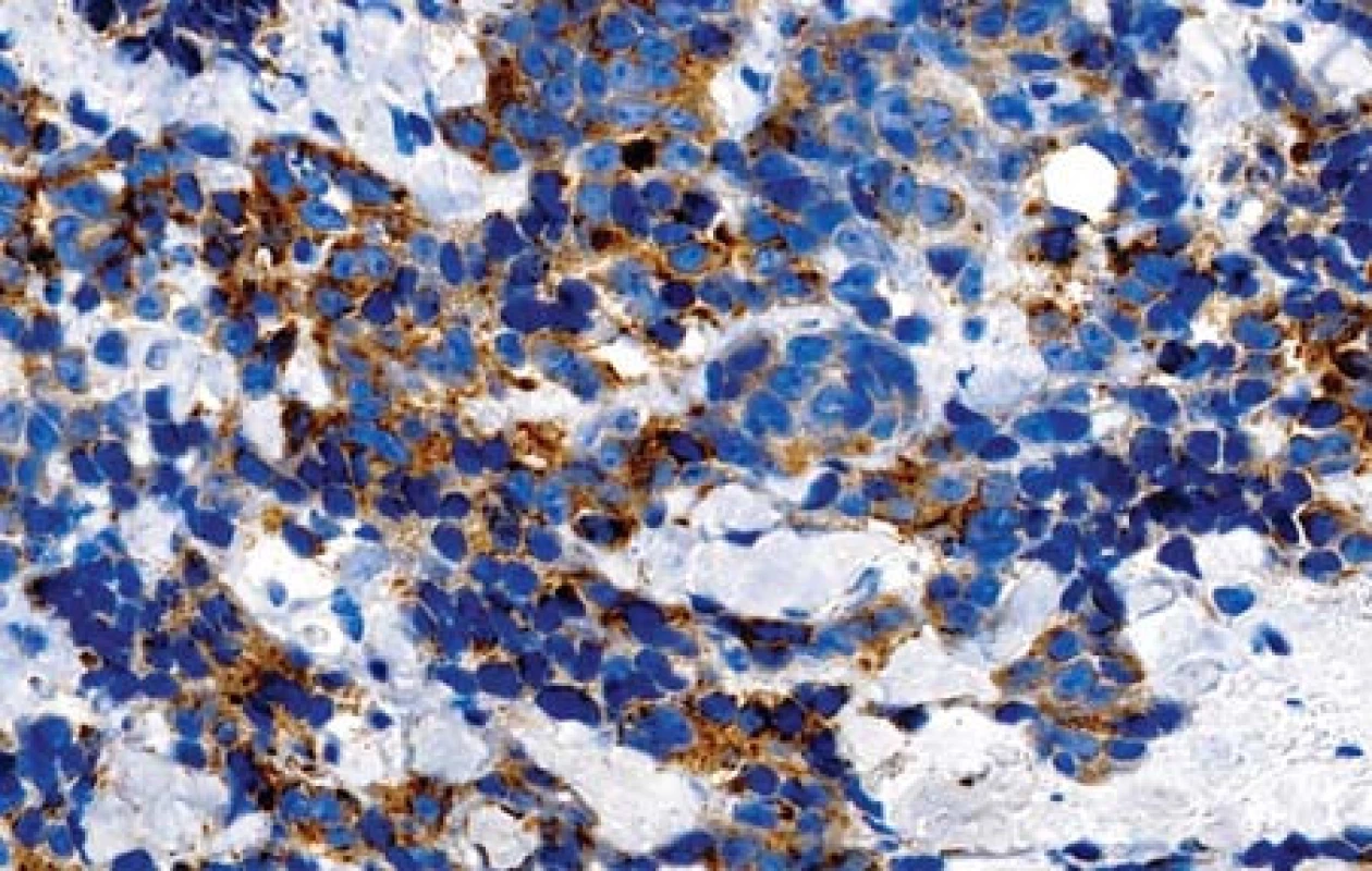 Pozitivní nález s protilátkou proti synaptofyzinu (imunohistologie, 400x).