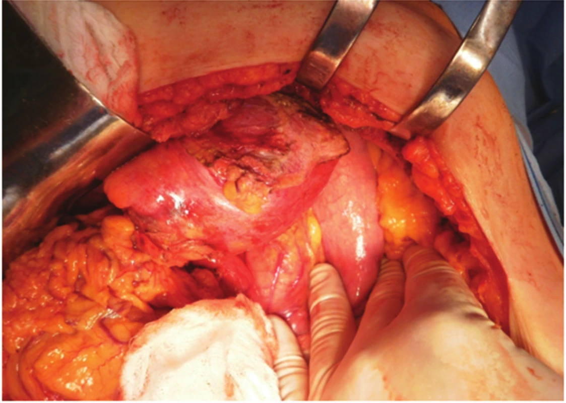 Peroperační pohled z příčné laparotomie, mobilizace pseudocysty od bránice
Fig. 4. Peroperative view from transversal laparotomy, mobilisation of the pseudocyst from the diaphragm