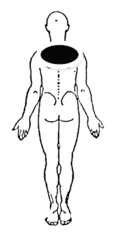 Lokalizácia bolesti u centrálneho symetrického posteriórneho derangementu (McKenzie, May, 2006).