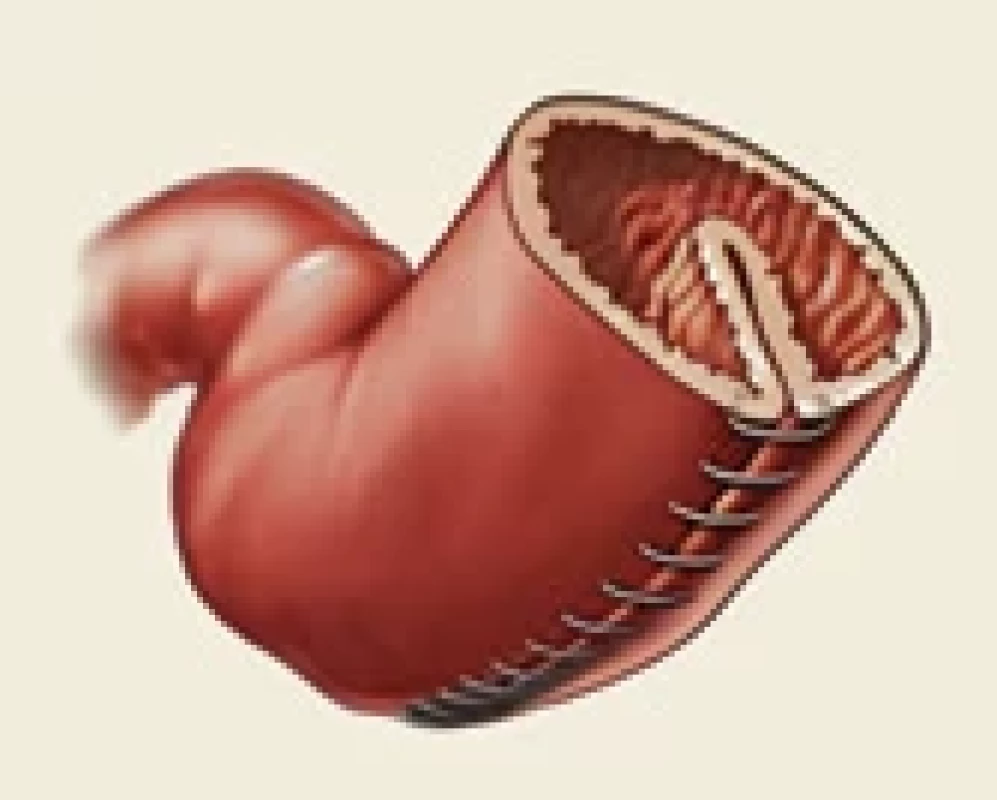 Plikace žaludku. Fig. 􀍷. Stomach plication.