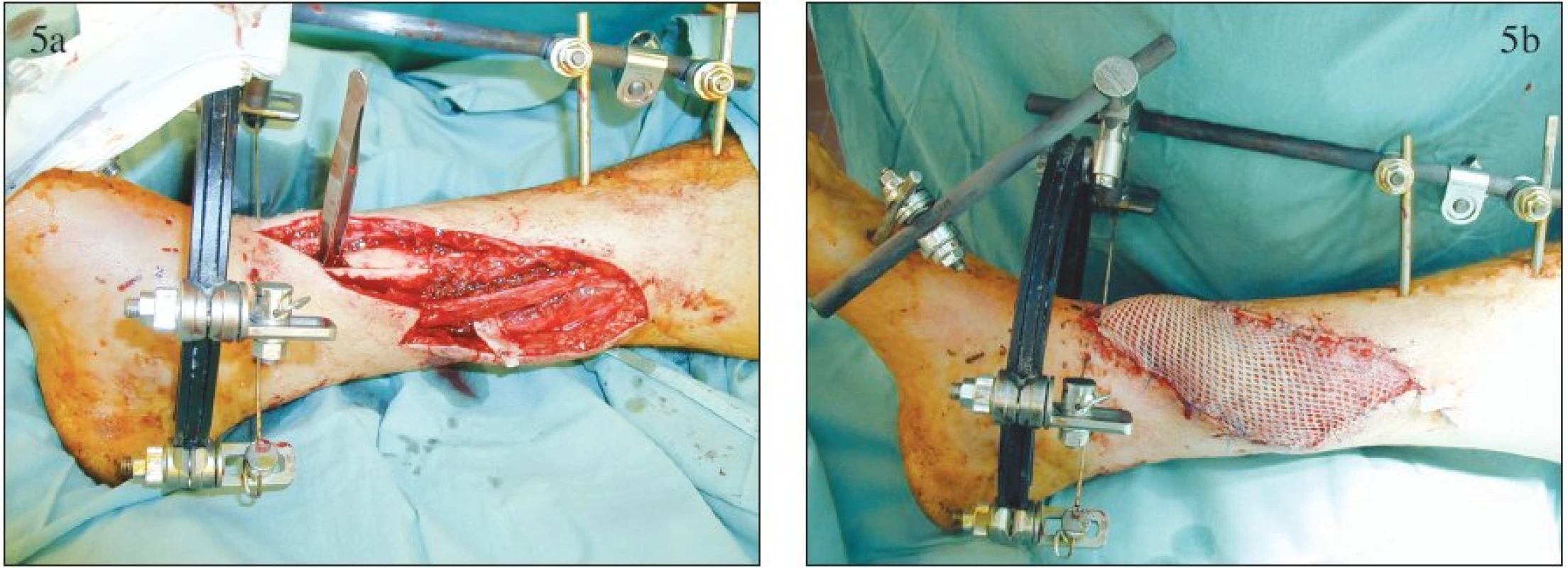 Krytí akutního defektu měkkých tkání bérce volným muskulárním lalokem: a – peroperační nález po provedení rozsáhlého debridement, b – přenesený lalok m. gracilis
Fig. 5. Coverage of the acute calf soft tissue defect with a free muscular flap: a – peroperative finding following extensive debridement, b – m. gracilis flap
