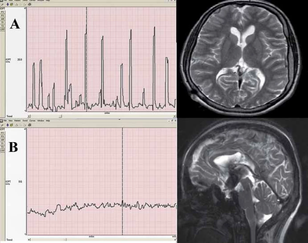 Křivky intrakraniálního tlaku pacientky 3 po softwarové analýze. Osa x – čas (zobrazeno 8,5 min), osa y – intrakraniální tlak (aktuálně měřítko s maximem 30 mmHg).
A – křivka intrakraniálního tlaku před endoskopickou ventrikulostomií, viditelné jsou elevace až k hodnotám 26 mmHg. Na snímku MR bez známek hydrocefalu.
B – křivka intrakraniálního tlaku po výkonu, normalizace hodnot, bez elevací. Na snímku MR mozku patentní stomie třetí komory.