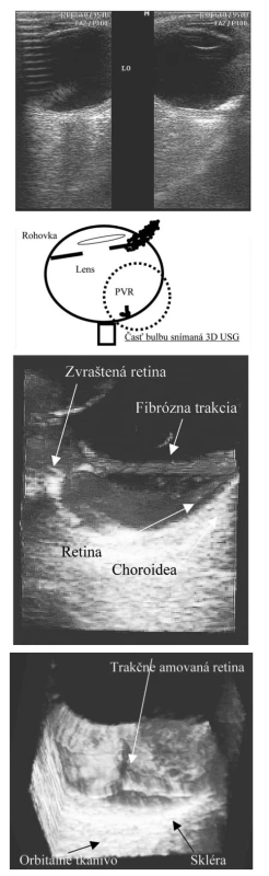 a. 2D USG zobrazenie vitreoretinálnej proliferácie
b. Schematické zobrazenie bulbu. Bodkovaný výsek predstavuje oblasť retiny s vitreoretinálnou proliferáciou – táto oblasť je zobrazená 3D USG na obr. 2 c, d
c. 3D USG vitreoretinálnej proliferácie. Na obrázku znázor-
Obr. 1 c. 3D USG zobrazenie zadnej strany dúhovky (zo strany nený detail fibróznej trakcie na sietnicu, zvrašťujúca sietnicu
d. 3D USG vitreoretinálnej proliferácie. Pohľad zhora na sietnicu.
Na obrázku zobrazený detail trakčne amovanej retiny