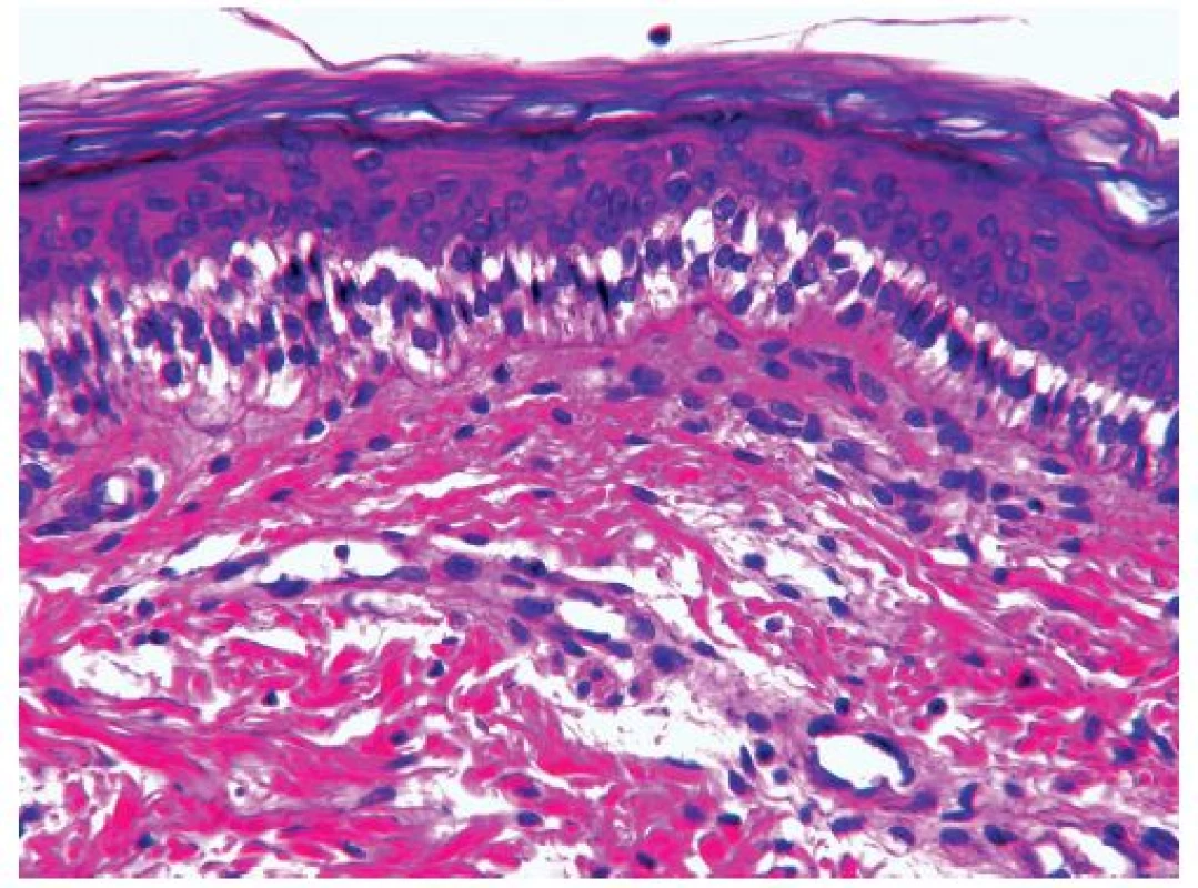 Epidermis z okraja bulóznych lézií s nápadnou cytolýzou a vakuolizáciou bazálnych keratinocytov („eraser effect”) (hematoxylín - eozín, zväčšenie 400x).
