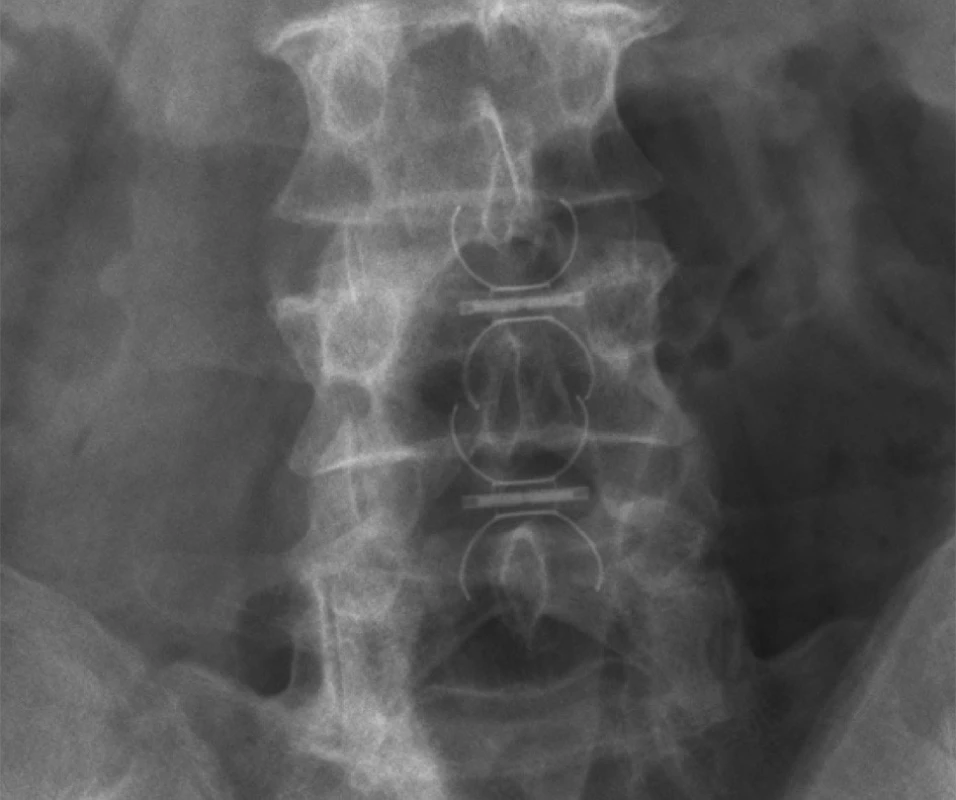 Skiagrafický snímek po operaci s vloženými In-Space v prostoru L3/4 a L4/5, AP projekce
Fig. 2: Fluoroscopy of In-Space implants at levels L3/4 and L4/5 after surgery, AP view