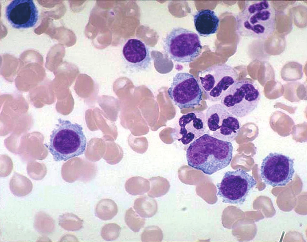 Tricholymfocyty.