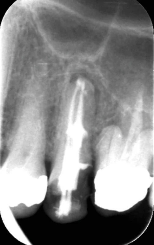 Obturácia koreňového systému s internou formou resorpcie teplou obturačnou technikou (Thermafil). Zdroj: Simona Fritzká. Fig. 8 An obturation of a root canal system with internal resorption using a warm obturation technique (Thermafil). Source: Simona Fritzká.