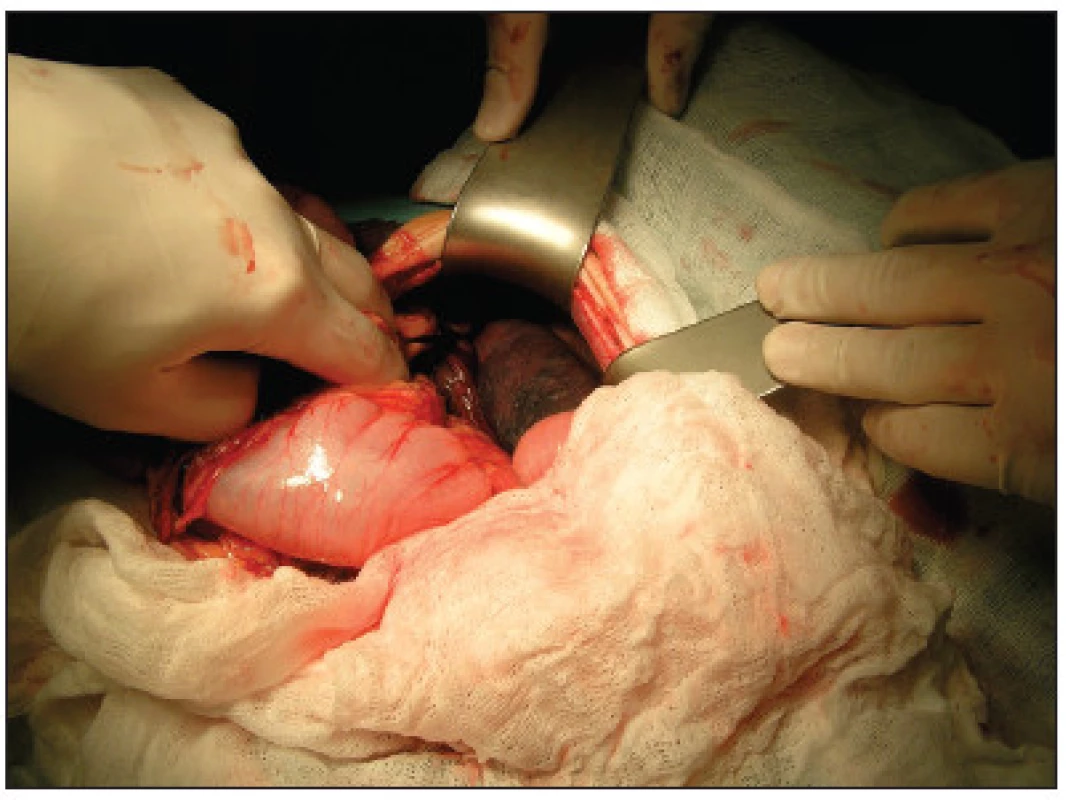 Ischemické zmeny sleziny
Fig. 7. Ischemic changes in the spleen
