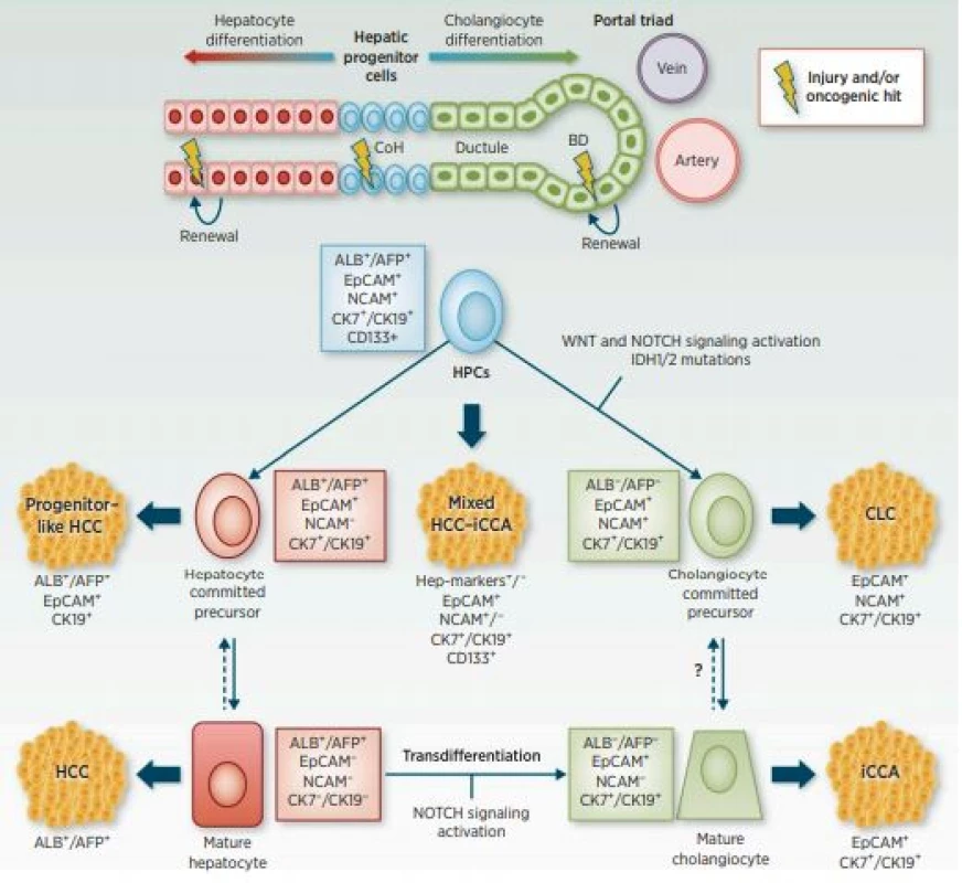 Schematické znázornění původu u primárních nádorů jater, diferenciace
v cholangiocelulární karcinom (převzato z: American Association for Cancer Research, 2016)