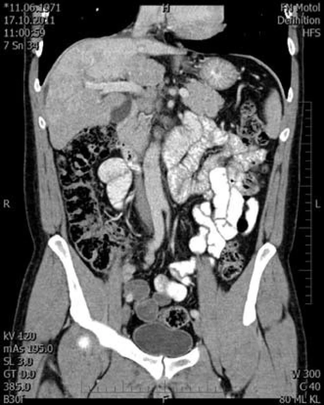 Venózní fáze v koronární rovině.
Fig. 6. Venous phase in the coronal plane.