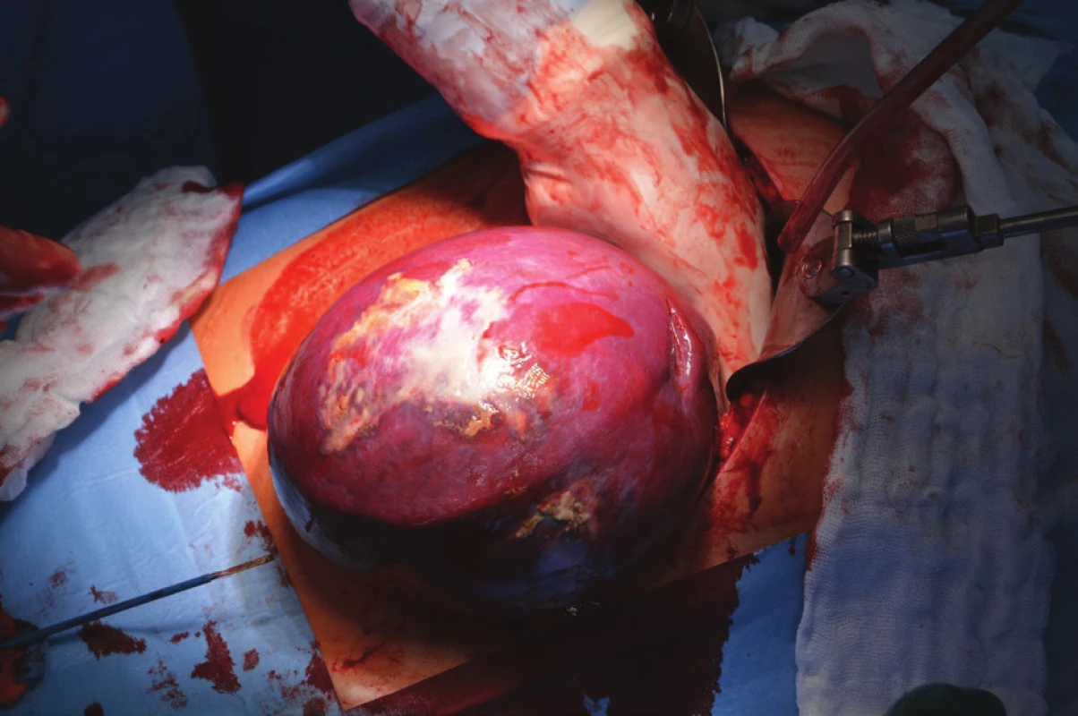 Peroperační foto sleziny během splenektomie
Fig. 5: Perioperative photo of the spleen during splenectomy